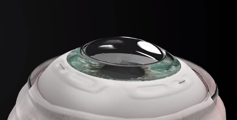 photo de la cornée synthétique KPro du laboratoire Corneat Vision mise en place sur un œil lors d'une opération de greffe de cornée